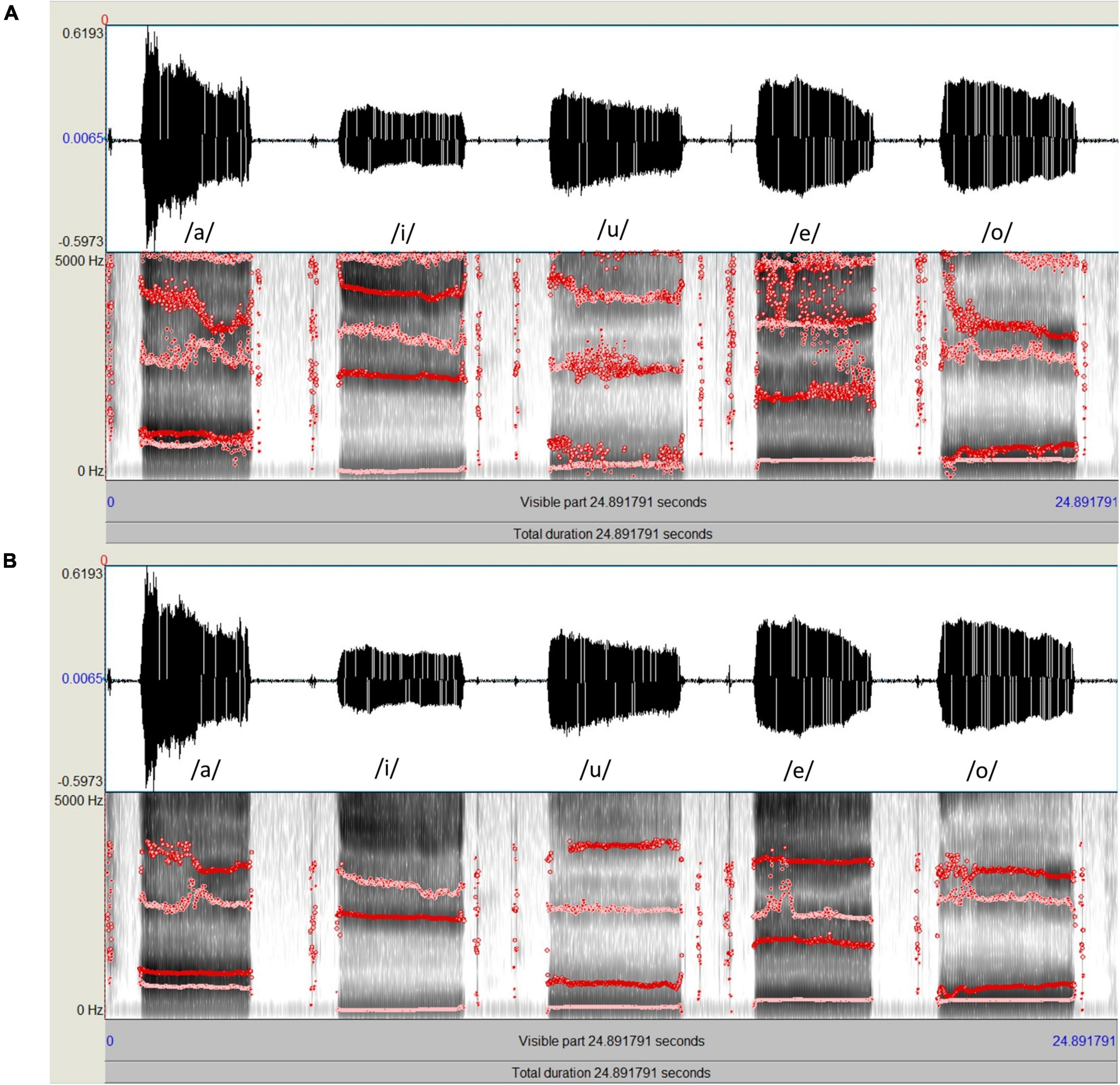 Comparison of Praat and Computerized Speech Lab for formant analysis of five Japanese vowels in maxillectomy patients